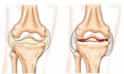 Gesundes und arthritisches Knie