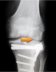 Arthrose des Kniegelenks